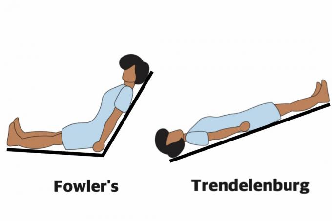 Fowler's ve Trendelenburg